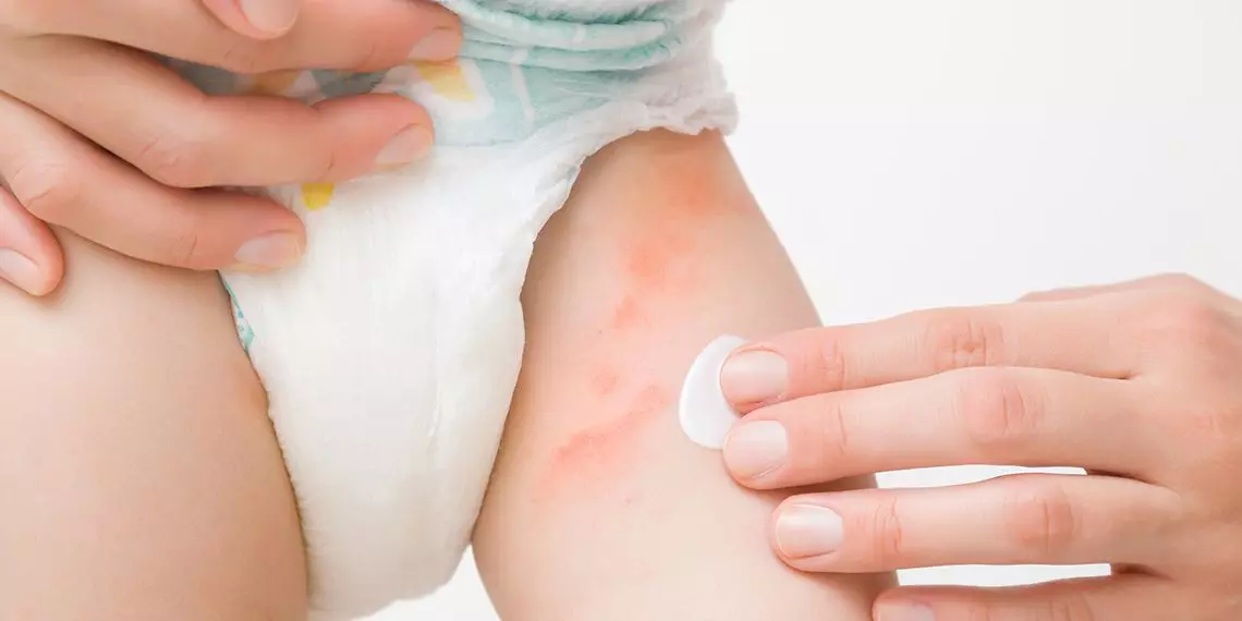 Northwest Family Clinics - Diaper Rash: Causes, Treatments, and Prevention Tips
