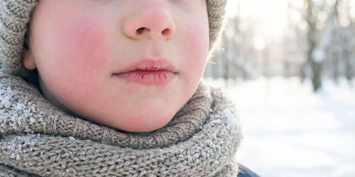 Close-Up of Chapped Lips in Cold Winter Air