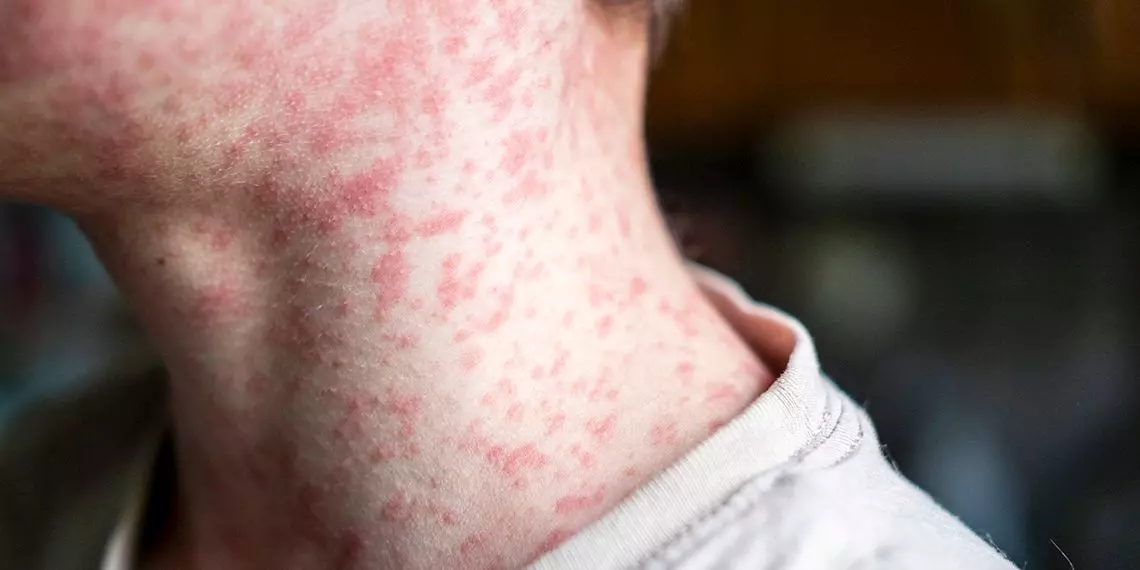 Northwest Family Clinics - Understanding Measles