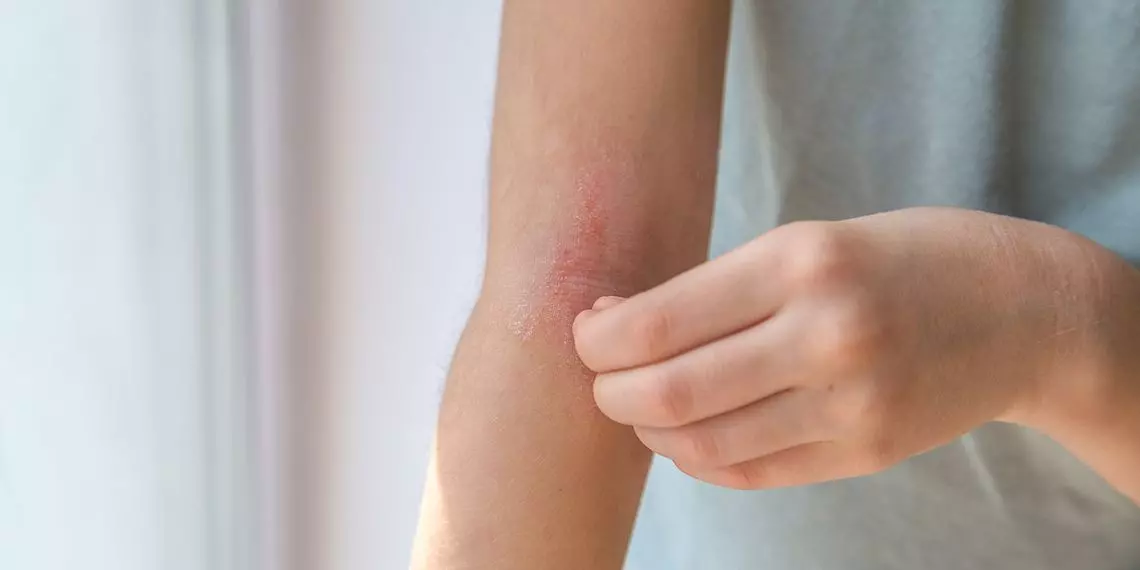 Northwest Family Clinics - What Is Eczema