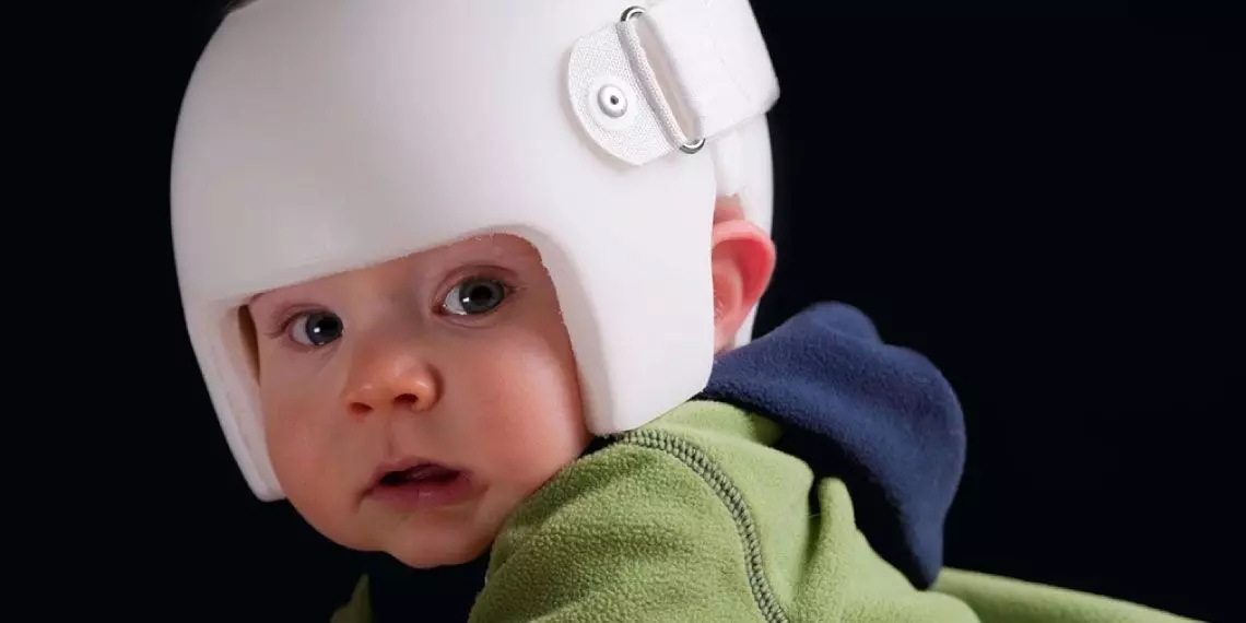 Baby wearing cranial helmet