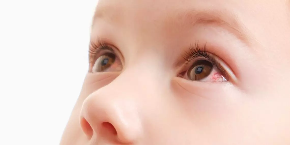 The three types of pink eye and how they differ