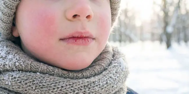 Close-Up of Chapped Lips in Cold Winter Air
