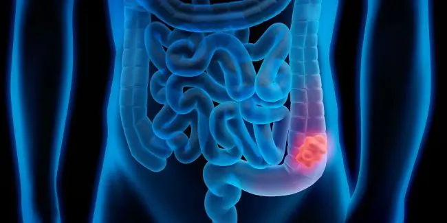 colorectal-cancer-and-importance-screenings.jpg