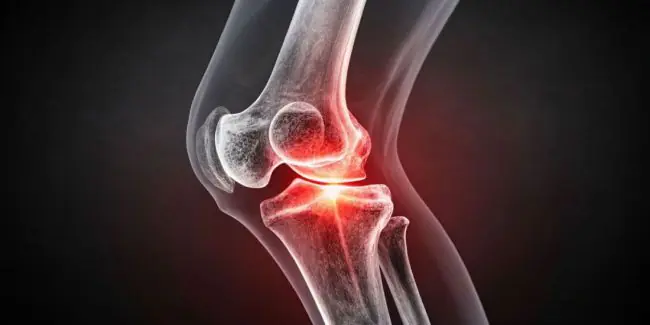 Knee joint inflammation during cold weather