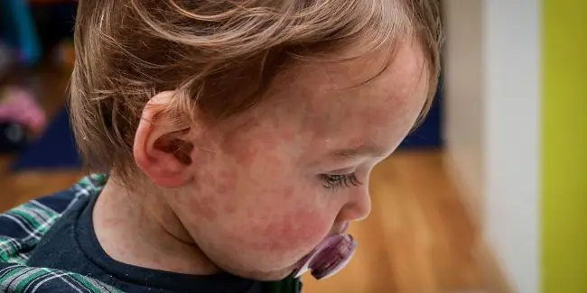 Northwest Family Clinics -  Understanding Measles
